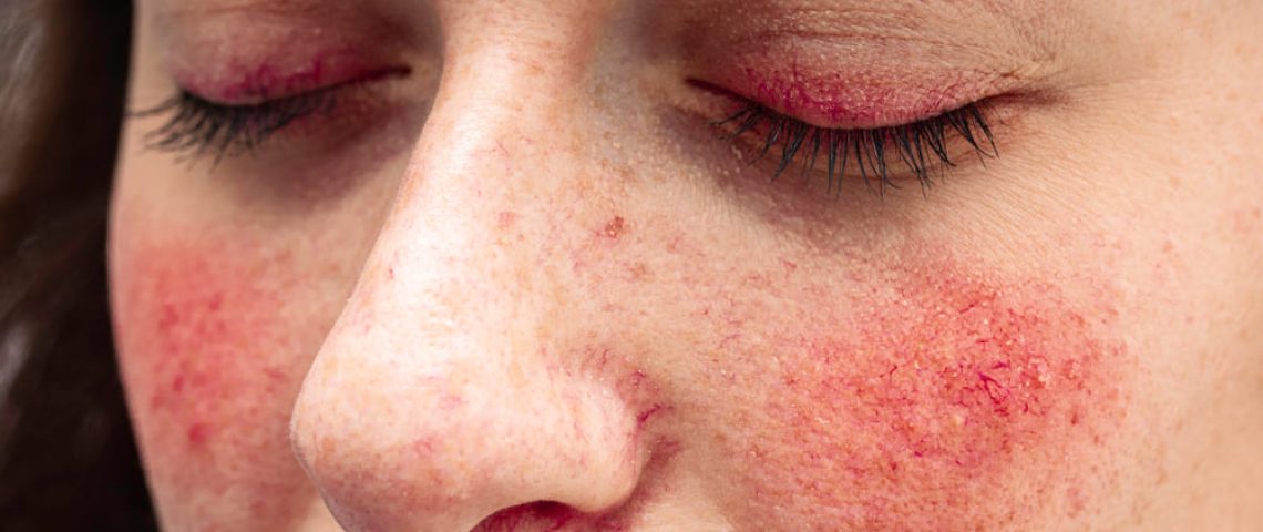 Cuperoza este o afectiune a pielii pe termen lung, care afecteaza in principal tenul