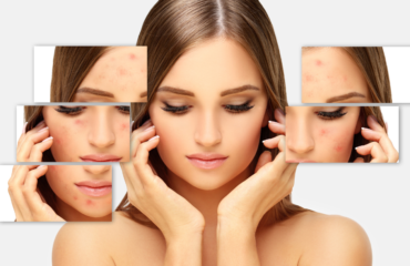 Efectele psihice si psihosociale ale acneei