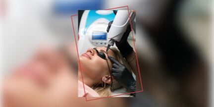 indepartare tatuaj laser