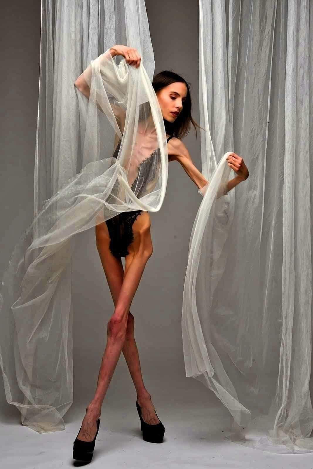 Anorexia nervoasă Cauze, simptome și tratament