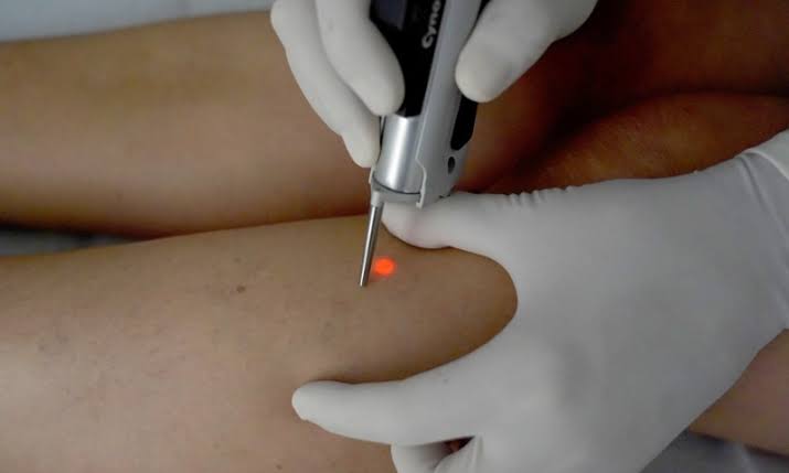 Laser vascular – capilare sparte