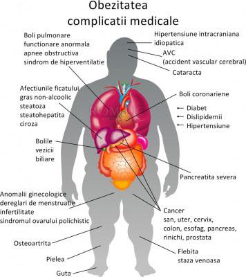 ObezitateaCe este, Cauze, Complicații si Tratament